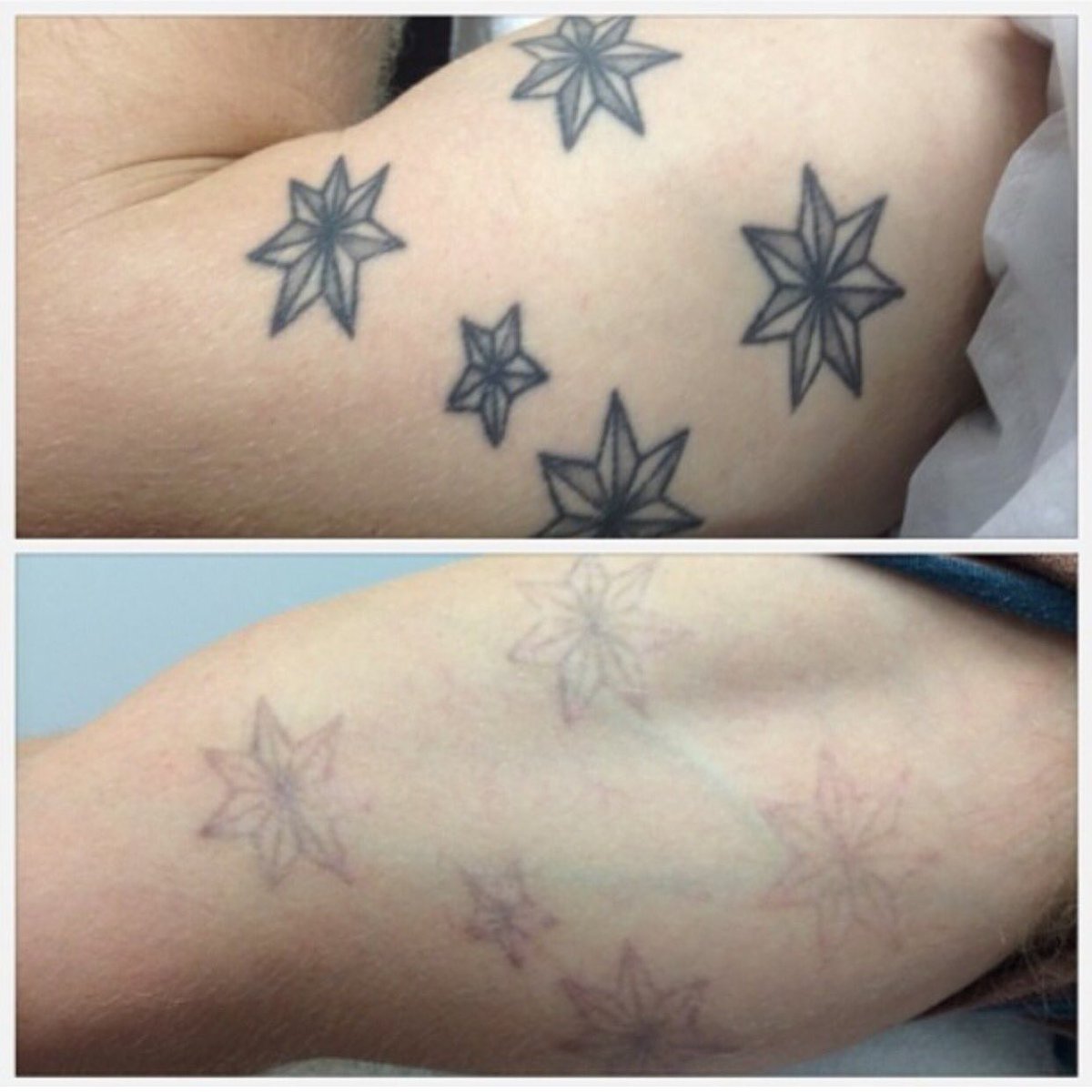 erasemyink's tweet photo. After 3 sessions #thinkb4uink #tattoofixers #tattoofix #tattooregret #lasertattoo #laserremoval #lasertattooremoval https://t.co/ar2h8D2SLi