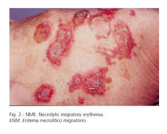 mentor_medical's tweet photo. #glucagonoma #MedEscape https://t.co/PylPa8oU8i