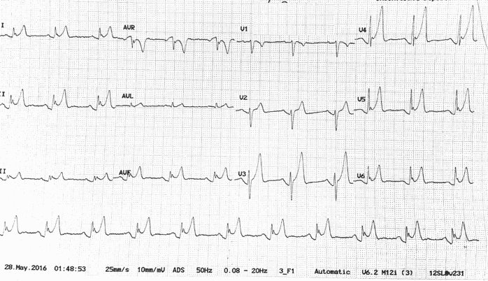 ECGclass's tweet image. 33 year old male with chest pain. Interpretation and management as always #ECGclass