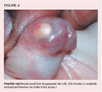 The clitoris retracting The clitoris retracting