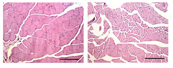 NatureMedicine's tweet photo. Targeting fatty acid–induced oxidative stress may prevent #cancer-induced cachexia: https://t.co/0pVsuTZ6eQ #ASCO16 https://t.co/XswJcTboMv