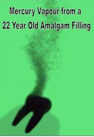 JusPauperum1's tweet image. The Government to ratify Minimata Treaty and phase out #MercuryAmalgam #DentalFillings.  community.sumofus.org/petitions/the-…