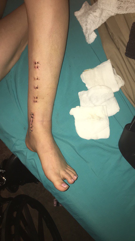 KristinCook24's tweet photo. Recovering from a broken tibia/fibula is NO fun👎 https://t.co/OpTQokRnm4