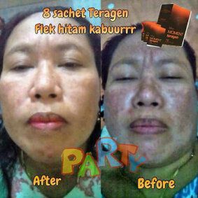 IndahVarista1's tweet photo. Karena minum Teragen, flek hitam kabur \=D/ yuk merapat sist,, More info n order chat me BB 29D596A3 https://t.co/qvfTmpctcv