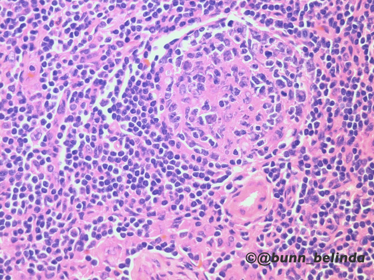 bunn_belinda's tweet photo. HIV-lymphadenitis: follicular hyperplasia, lysis, hyalinization &amp; involution (++++plasma cells). #pathology https://t.co/HrniwGU9U2