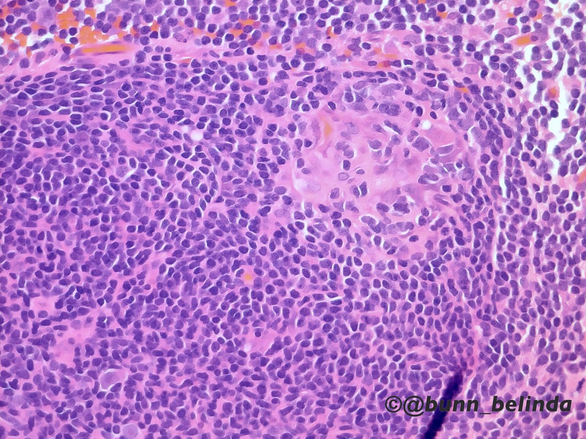 bunn_belinda's tweet photo. HIV-lymphadenitis: follicular hyperplasia, lysis, hyalinization &amp; involution (++++plasma cells). #pathology https://t.co/HrniwGU9U2