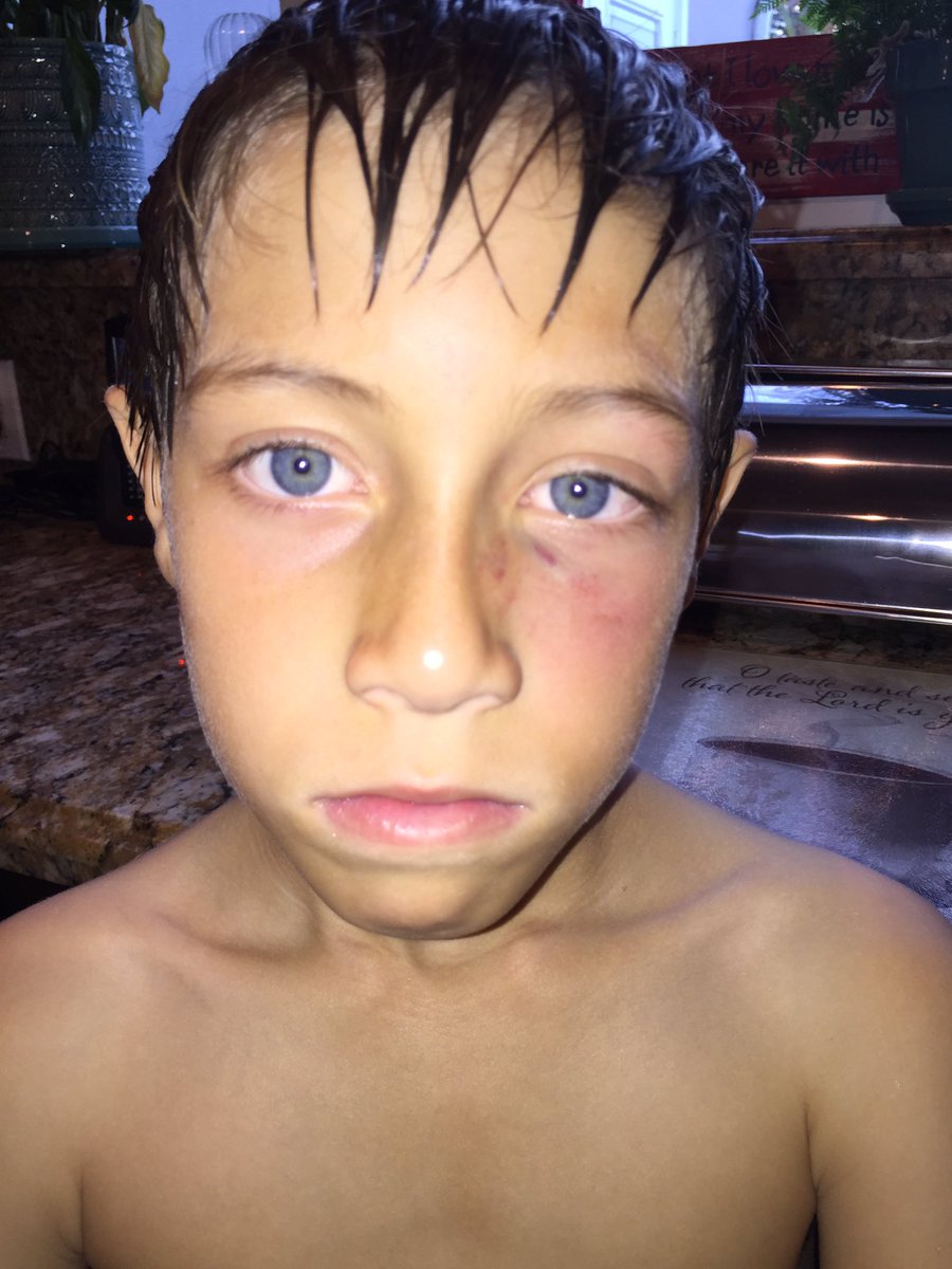 lilmeta's tweet photo. My eight year old got hit with a line drive in the face and didn't even cry😂#ToughGuy #baseballsoldier https://t.co/hsE7fL1HoC