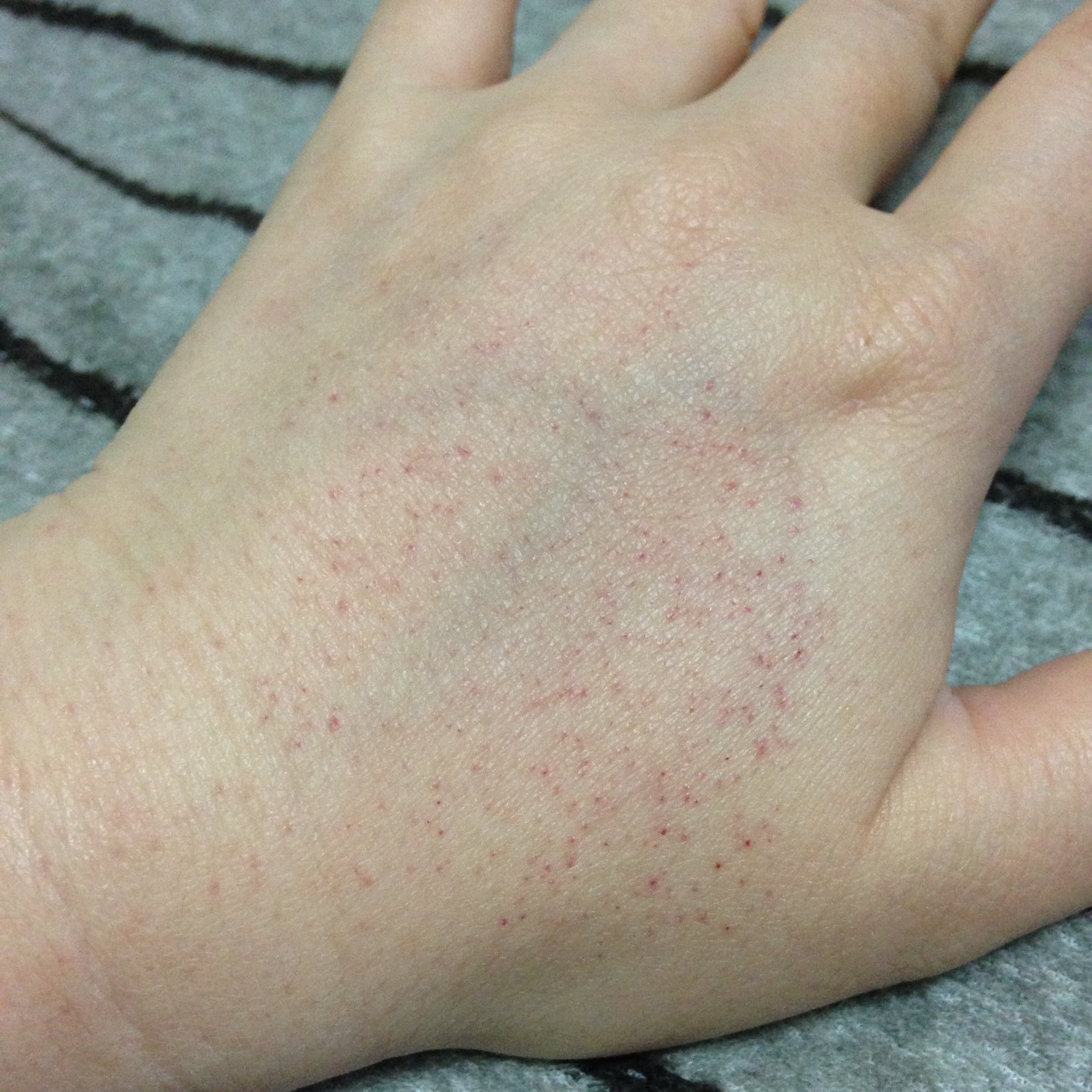 あ太郎 げっ 起きたら痛くも痒くもないツルツル謎の赤い斑点 皮膚科に行ったら 腕を体下で圧迫したりすると鬱血して出来るようなので一安心 食中毒でこんな感じになることもあるようなので皆様もご注意を あ太郎 げっ 起きたら痛くも痒くもないツルツル謎の赤い斑点 皮膚科に行ったら 腕を体下で圧迫したりすると鬱血して出来るようなので一安心 食中毒でこんな感じになることもあるようなので皆様もご注意を