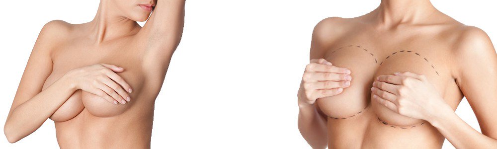 corporalcore's tweet image. Cirugía de aumento de senos. ow.ly/3dsX300ItwG