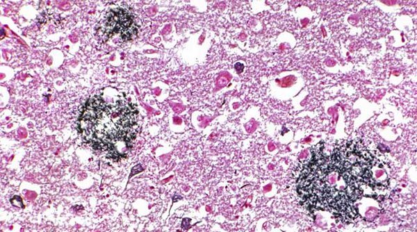 sciencebeta's tweet photo. Protein research offers promising potential treatment of #Alzheimer's disease https://t.co/U8uHA46ymj https://t.co/x81YpgAXx0
