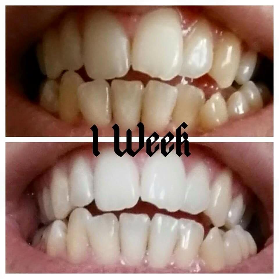SteffBirch's tweet photo. #PeroxideFree #WhiteningToothpaste #AmazingResults #SeeingIsBelieving 
 Dm me for more details :) https://t.co/TAVHTE9gsJ