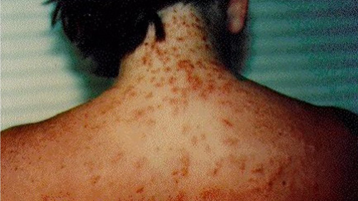 Sea lice outbreak found along South Florida beaches bit.ly/1RXe4Br?utm_me… https://t.co/PdJhplQj8U