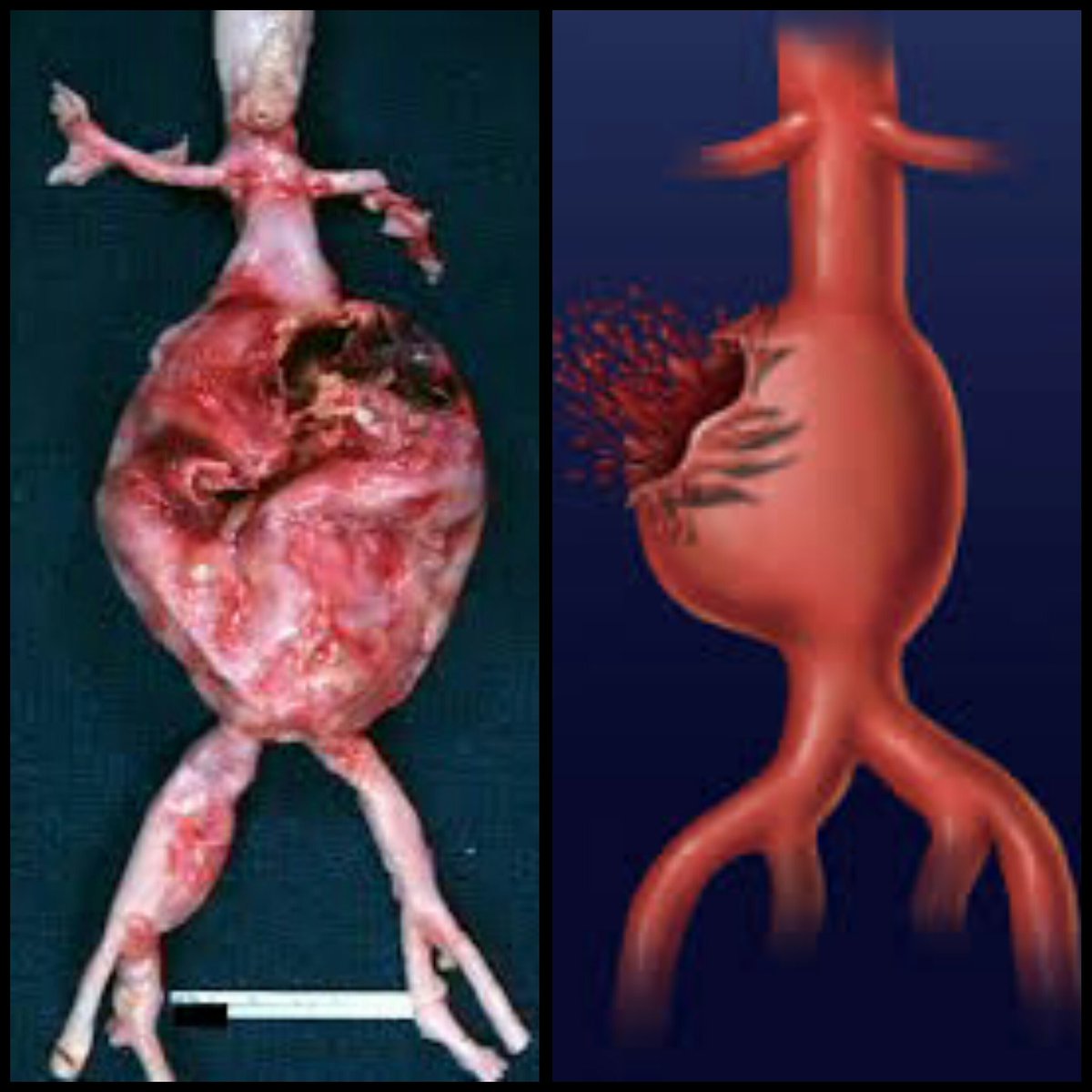 Carla Valentine On Twitter Today S Autopsy Case Ruptured Triple A Find Out More On My Remains2beseen Instagram Pathology Https T Co Zmjvjxvj4u Twitter