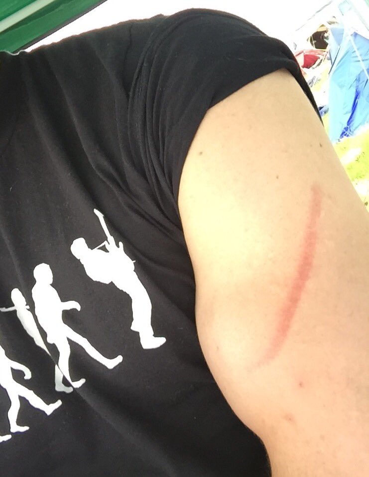 hoops__45's tweet image. Got hit by a broken bungee strap :( #ouch #campingproblems