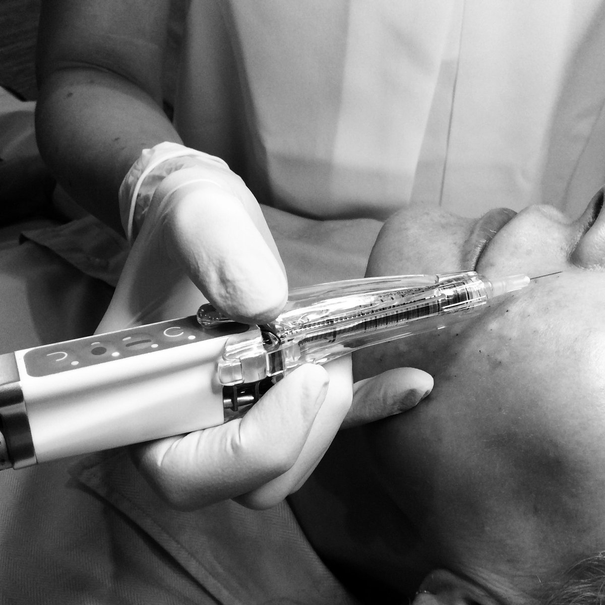 CosmeDocs (@cosmedocs) on Twitter photo Skin meso demo with #teosyalpen earlier today <a href="/TeoxaneUK/">Teoxane UK</a> <a href="/Teoxane/">Teoxane Laboratories</a> ๐๐๐ป Skin meso demo with #teosyalpen earlier today <a href="/TeoxaneUK/">Teoxane UK</a> <a href="/Teoxane/">Teoxane Laboratories</a> ๐๐๐ป