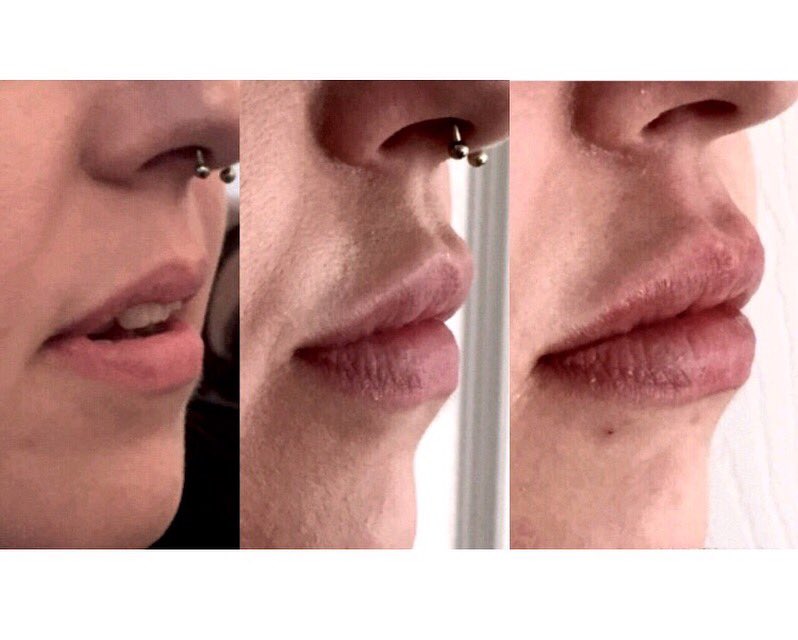 Elle_Aura_'s tweet photo. #lipjourney #dermalfillers #before #1ml #2mls #smooth and #flat to #volumised and #curvy 👄 #plump #pout #liplove 😍❤️ https://t.co/eGrIqquv5P