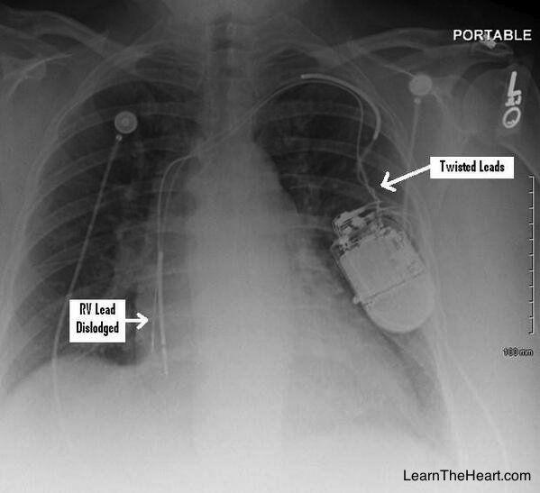 LearntheHeart's tweet photo. Twiddler's Syndrome: Patient twists Pacer/ICD box under skin ➡ dislodged RV lead #cardiology #ICD #USMLE #MedEd https://t.co/kN0dm6ttFA