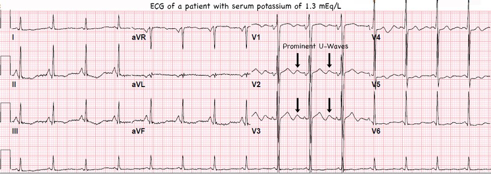 PROFOUND HYPO K+

These are what U-Waves look like. Extra "humps" after T-Waves. Best seen in V2 &amp; V3!

#ECG #FOAMed