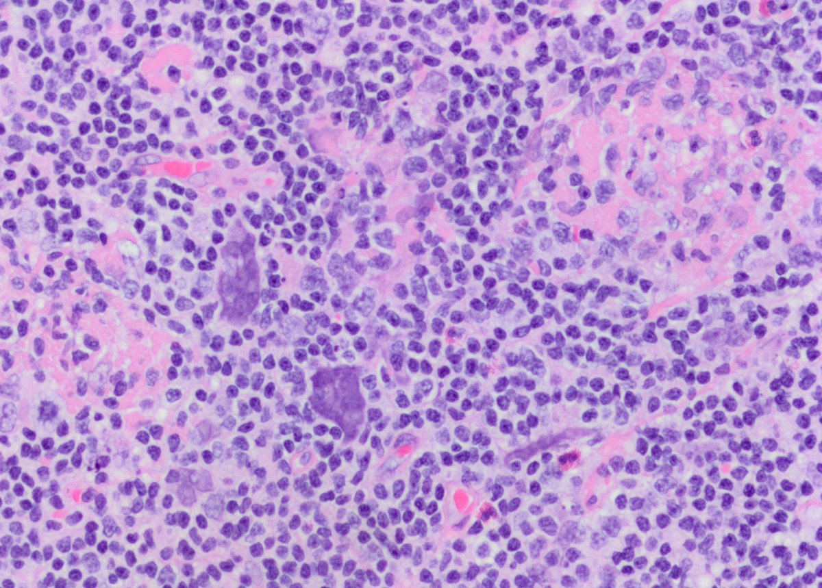 jollybob111's tweet photo. Case of Kimura disease. #pathology #eosinophils #warthin-finkeldey-cell #knoworfail https://t.co/X2tqCl9BJm