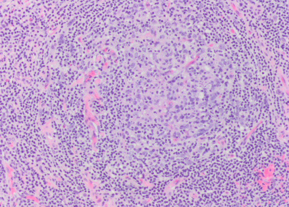 jollybob111's tweet photo. Case of Kimura disease. #pathology #eosinophils #warthin-finkeldey-cell #knoworfail https://t.co/X2tqCl9BJm