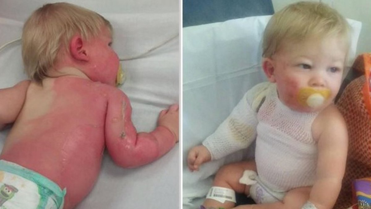 9-month-old boy badly burned from scalding water out of garden hose bit.ly/1U5cwNq?utm_me… https://t.co/lzBlUx1JQJ