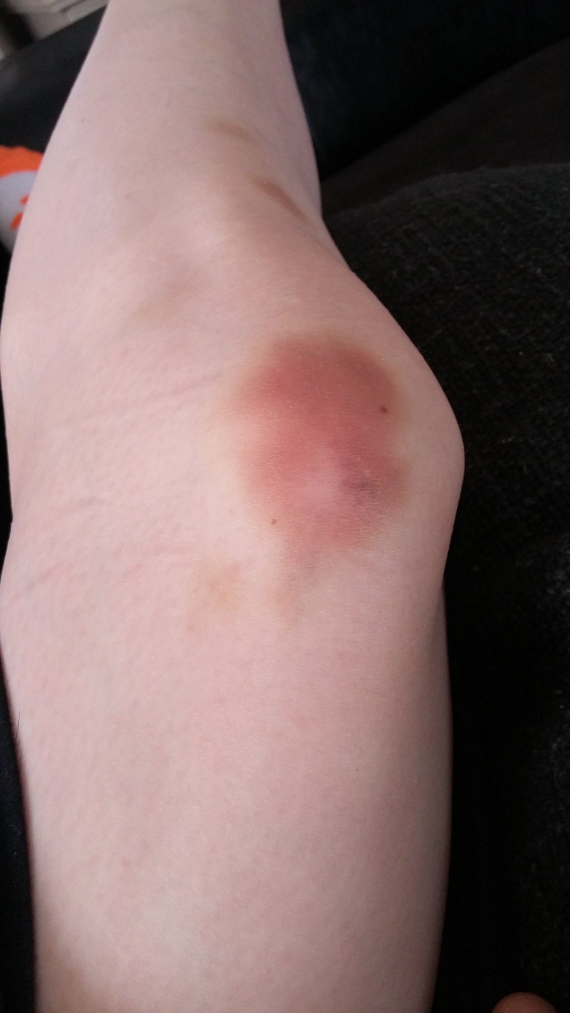 Bruised kneecaps cheap