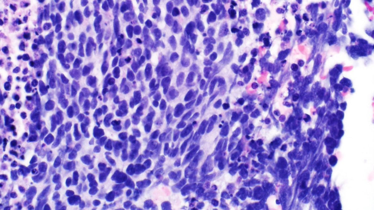 MaxwellSmithMD's tweet photo. 65yo hilar lung mass.  Small cell or NSCLC?  That is the question. Seemed so easy in training! https://t.co/7tv1KVNYj2