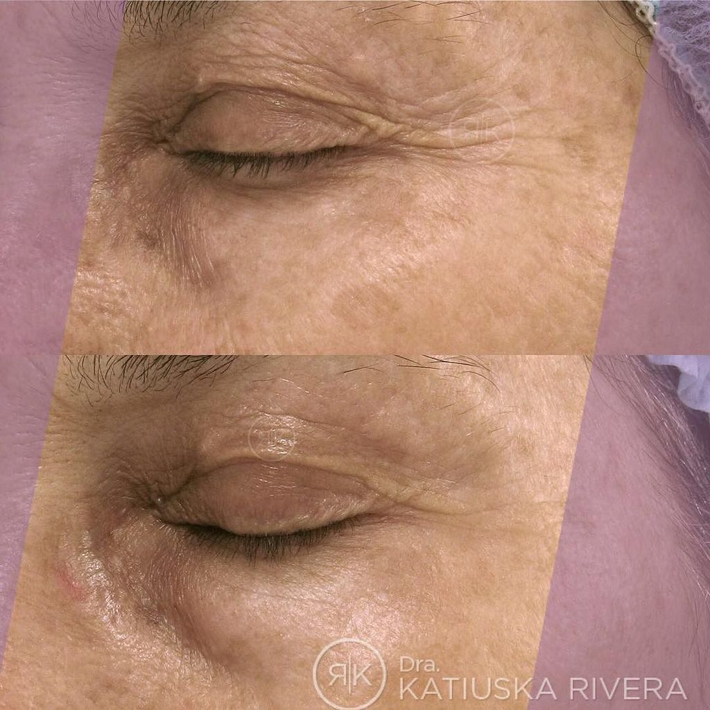 DraKatiuskaR's tweet photo. Este es el resultado pre y post de 2 sesiones de #Microresurfacing Láser que realice en pa… https://t.co/4dqxB7ZzgO https://t.co/btZhmpc2AV