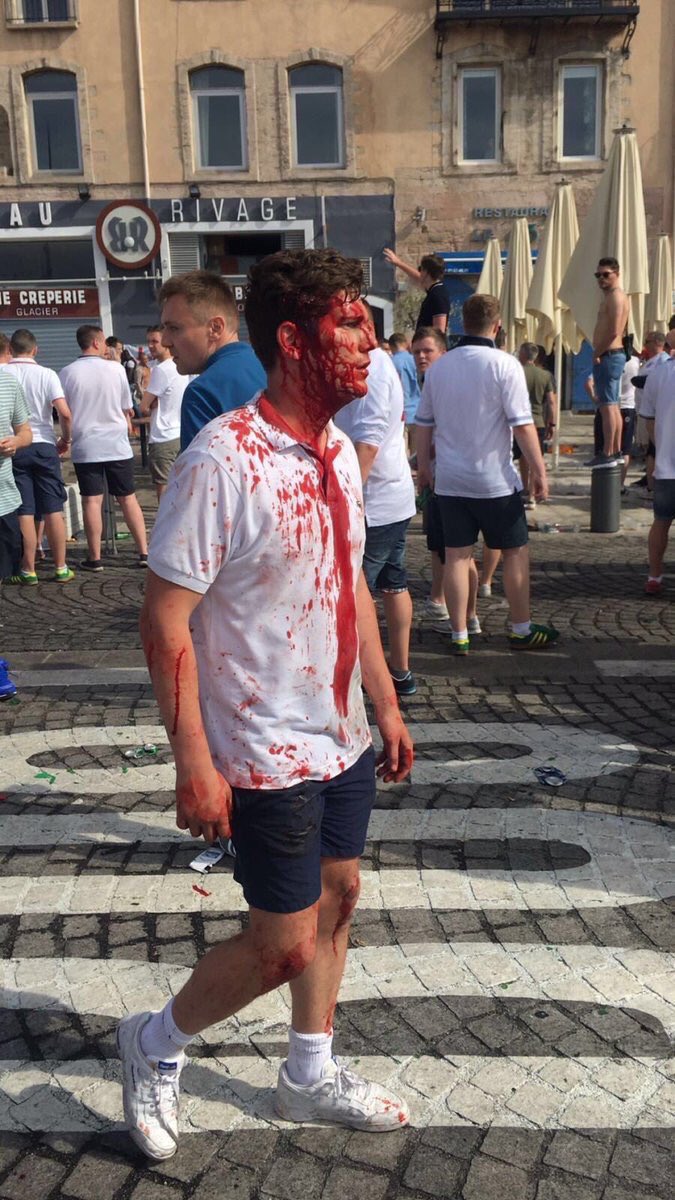 RienAFoot__'s tweet photo. Quand t'oublies ta casquette alors que ton équipe joue à Marseille alors t'as ton petit nez qui coule. #EURO2016 https://t.co/RGe1m9oz6W
