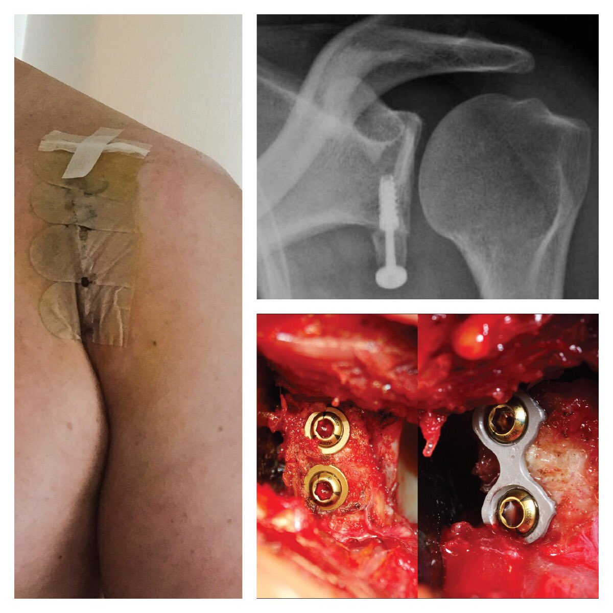 gorkemk's tweet image. My shoulder reconstructed. Almost a cyborg now😁 #latarjetprocedure Thanks to @vkv_amerikan and Prof. Mehmet Demirhan