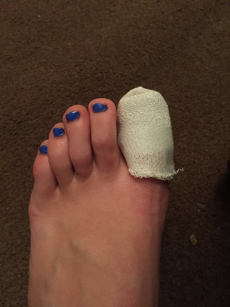 helensuthers's tweet photo. My first sports injury! I'm a real athlete now. Thankfully only an infected toe #ManVHorse #teamwholeearth https://t.co/J83QkEWRq2