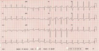 ECGclass's tweet image. 43 year old man. Has ECG as part of well-man check. He is asymptomatic. #ECGclass