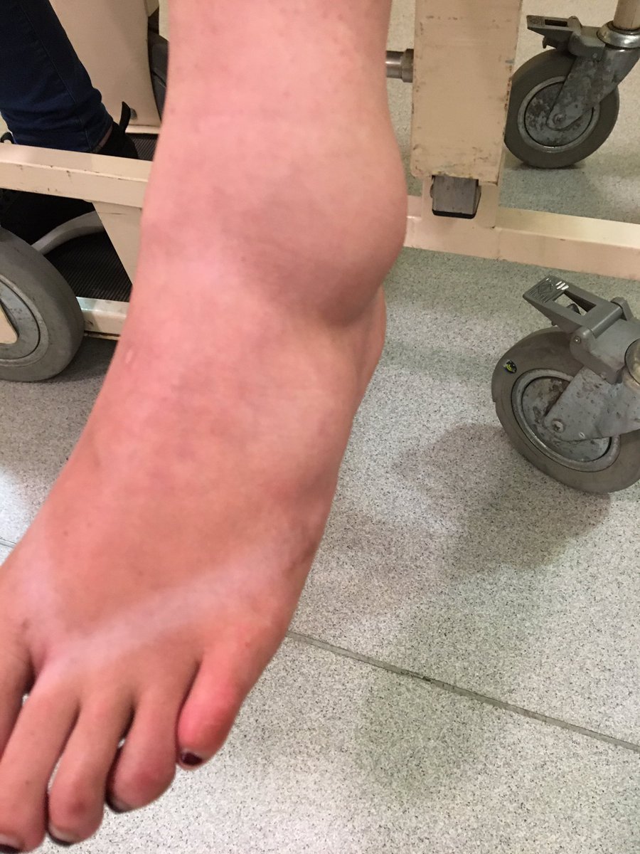 Can't believe it !! Arrive home today from <a href="/iom_tt/">Isle of Man TT</a> and <a href="/CowardJordan/">Jordan Beth Coward</a> falls out of van unloading it #brokentendon  🙈