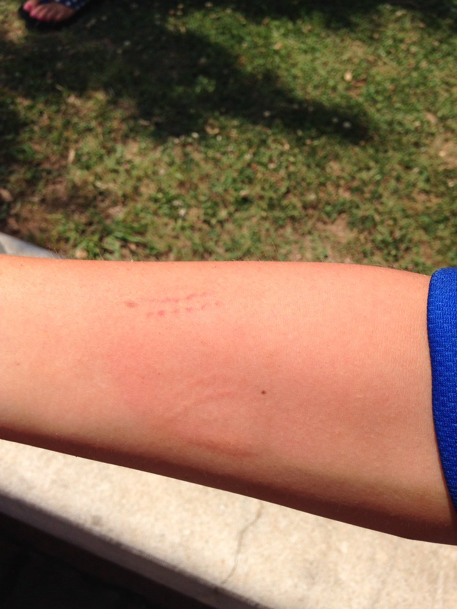 2CrewSarge's tweet photo. Battle scar. #baseball #mysonisacatcher #stitchmarks https://t.co/cRFTSIlbCN
