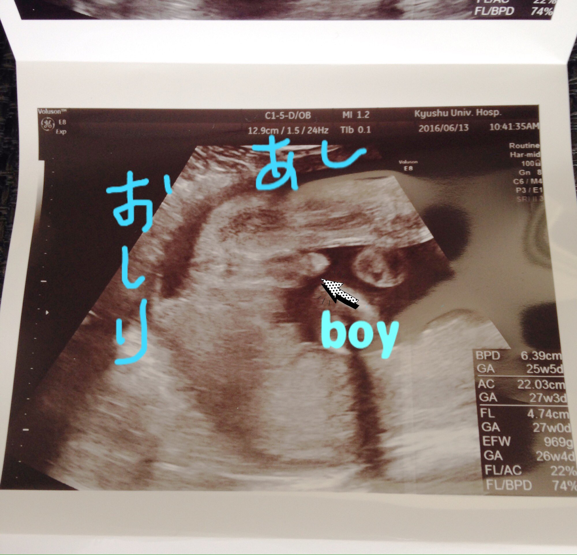 ピノ あと今回の検診でお腹の子の性別確定した 前回も聞いたけど今回は男の子のシンボルが私でもはっきりと確認できたしエコー 写真も貰えたのでお腹の子には悪い気もするけどエコー写真お披露目しときます T Co 2cnjjklbfm Twitter