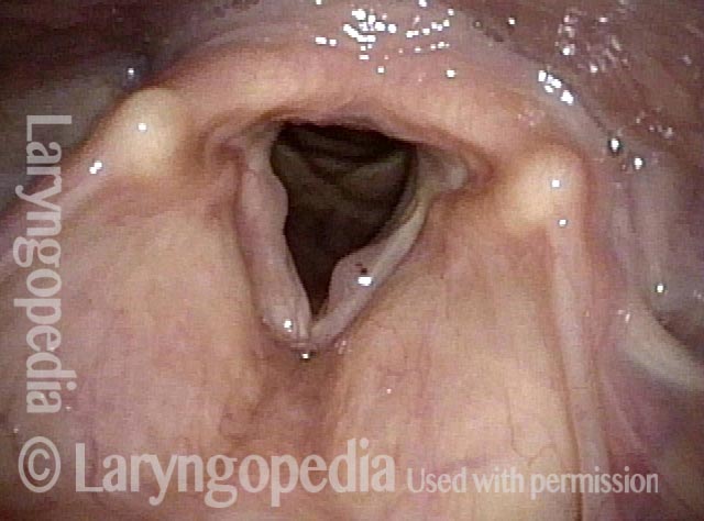 bastianvoicedoc's tweet photo. #Polyps or #Papillomas?
https://t.co/rYSQPtqZuk https://t.co/PYLCPE7Xge