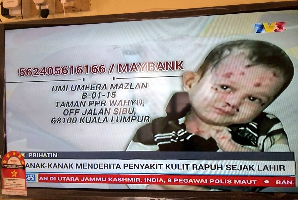 dodolism_'s tweet photo. Tengok berita tadi, kesian tengok adik ni menderita penyakit kulit rapuh. Sama sama lah kita bantu, sebarkan gais. https://t.co/FJ8JzK3lD4