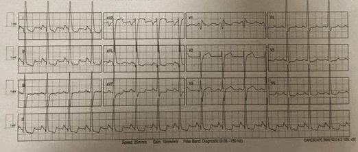 ECGclass's tweet image. 70 year old man with decompensated HF. Echo: LVEF of 15%. ECG done. Interpretation then management. #ECGClass