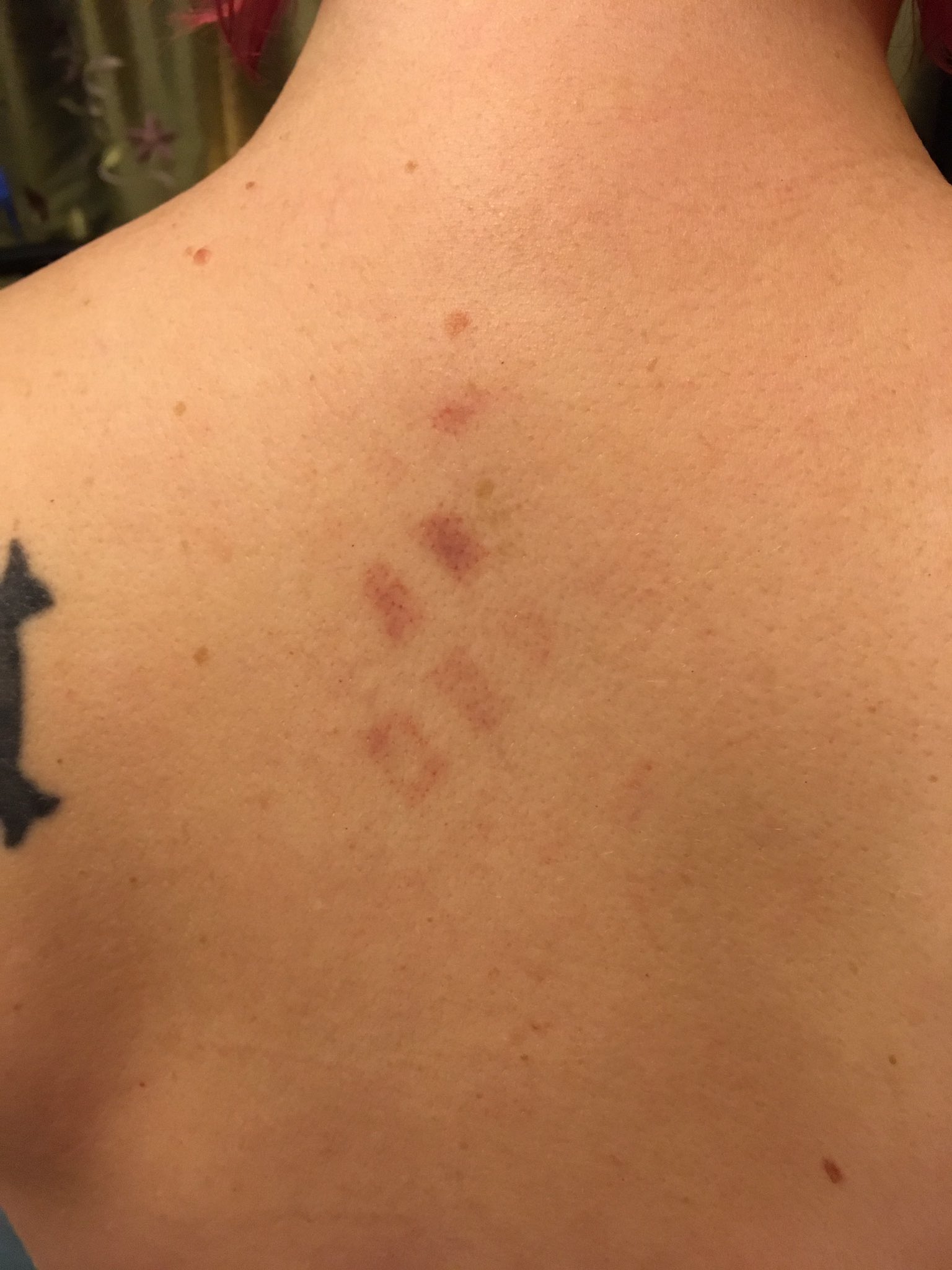 Kat Stark on X: Mysterious crosshatch bruise appeared on my back. Have no  explanation. Tried on all shirts/bras worn recently but ??   / X