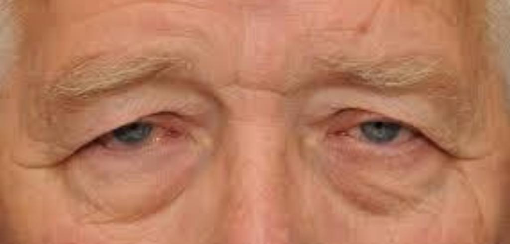 Eye_Atlas's tweet photo. #Dermatochalasis  excess skin upper or lower eyelid "baggy eyes." Acquired/congenital. Treated #blepharoplasty . https://t.co/jVf6IScTwq