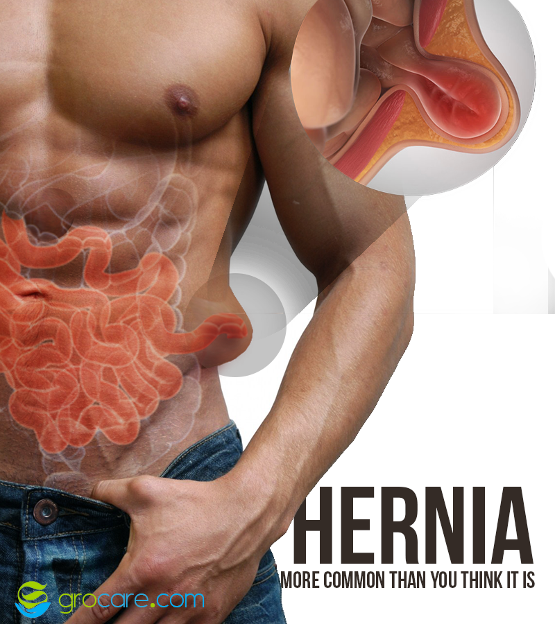Grocare_India's tweet photo. #GoGrocare Heal Hernia without Surgery https://t.co/KDxoNYhVw0 https://t.co/U0dU2UyojH