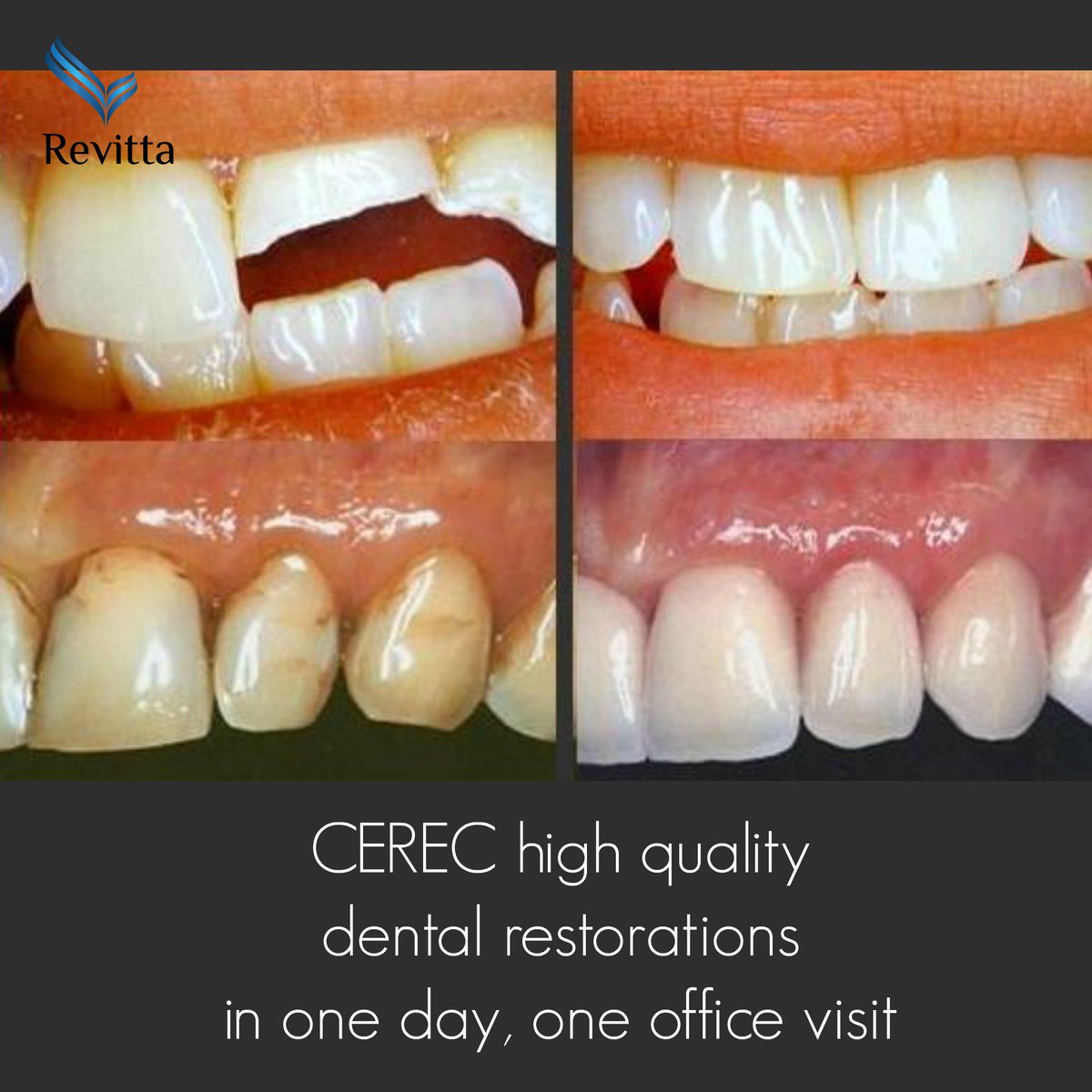 orthosnapny's tweet photo. https://t.co/Rnbyxaap28 #ToothCrown #dentist #teeth #smile #PorcelainCrown #ToothCap #DentalCrown #dentist #brooklyn https://t.co/9GO2lOJfII