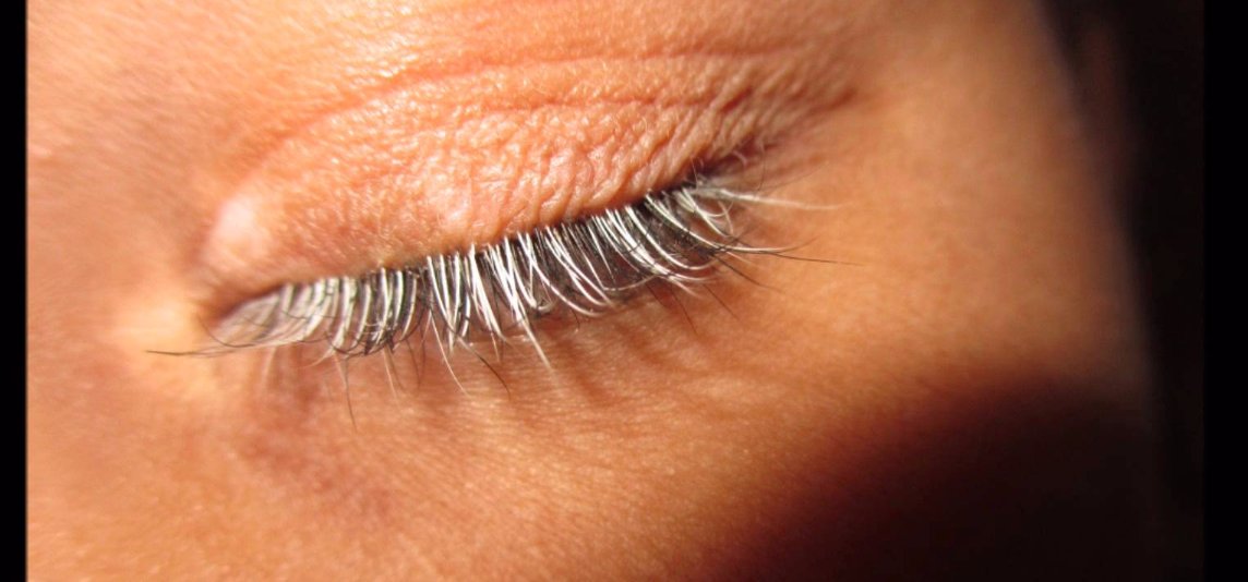 Eye_Atlas's tweet photo. #poliosis, premature whitening eyelashes due to ocular or systemic causes eg: Sympathetic ophthalmitis, blepharitis https://t.co/1X3FJ92Yx6