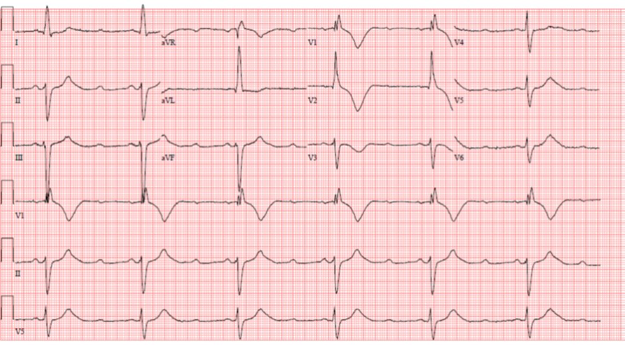 Rare 4:2 (?infrahisian) block transitioning to 3:1. 2nd beat must fall in narrow supernormal window #ECG #cardiology