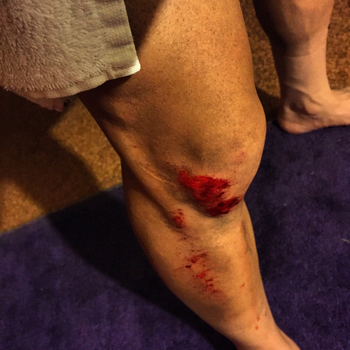 timaxiom's tweet photo. #DCR #laiditdown #coloradocyclist #urbancyclist #roadrash https://t.co/Z8WhWQe6RS