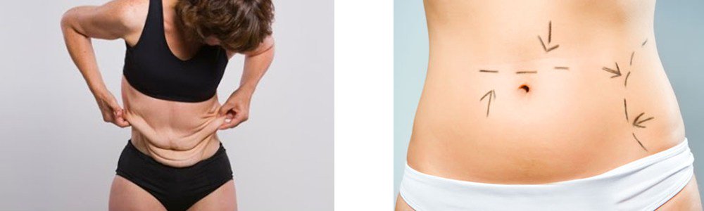 corporalcore's tweet image. Obesidad y sobrepeso #tratamiento corporal core ow.ly/KYTS300ItDm