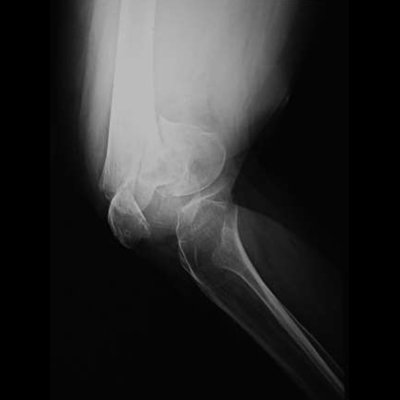 jointsmasters's tweet photo. Osteoporotic fracture around knee may not be amenable to fixation, need replacement using tumour prosthesis https://t.co/isht6ZCQrR