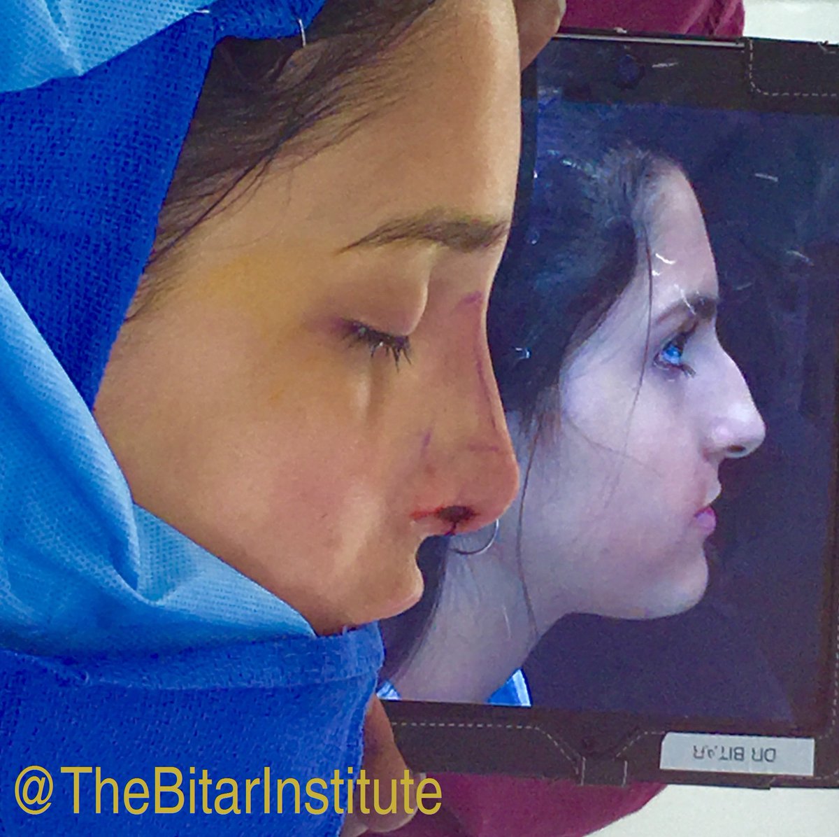 BitarInstitute's tweet photo. Check out these immediate #rhinoplasty results! #teambitar #drbitar #plasticsurgery #nosejob #nosesurgery https://t.co/ETyonsgrFX