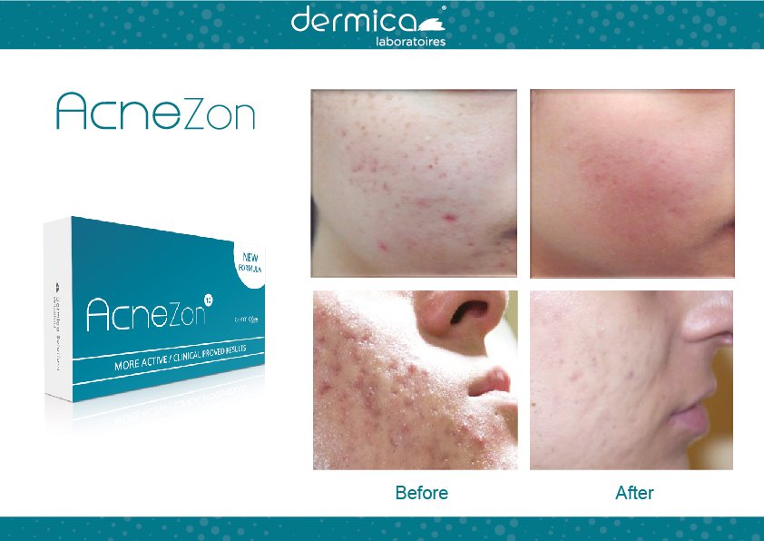ACNEZON has been developed to combat all forms of acne, both non-inflammatory...
dermica.ch/en/prod_442_42…