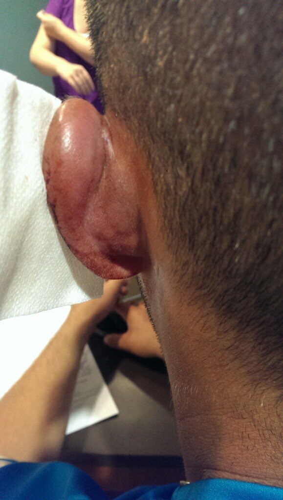 Aaron_Rudisill's tweet photo. Forgot to duck the 2nd time the ball was thrown at my head #Earholed https://t.co/uM4cmxi0Kp